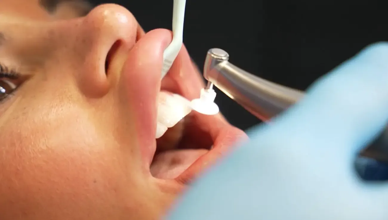 Porcelain veneers or composite bonding: which suits your smile?
